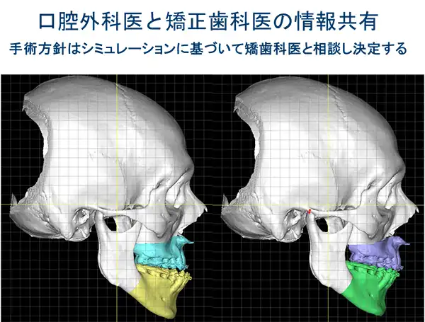 口腔外科医と矯正歯科医の情報共有