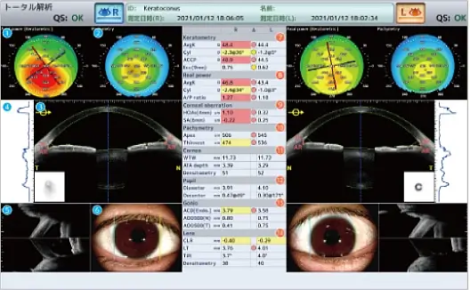 前眼部三次元画像解析（CASIA2 Advance）